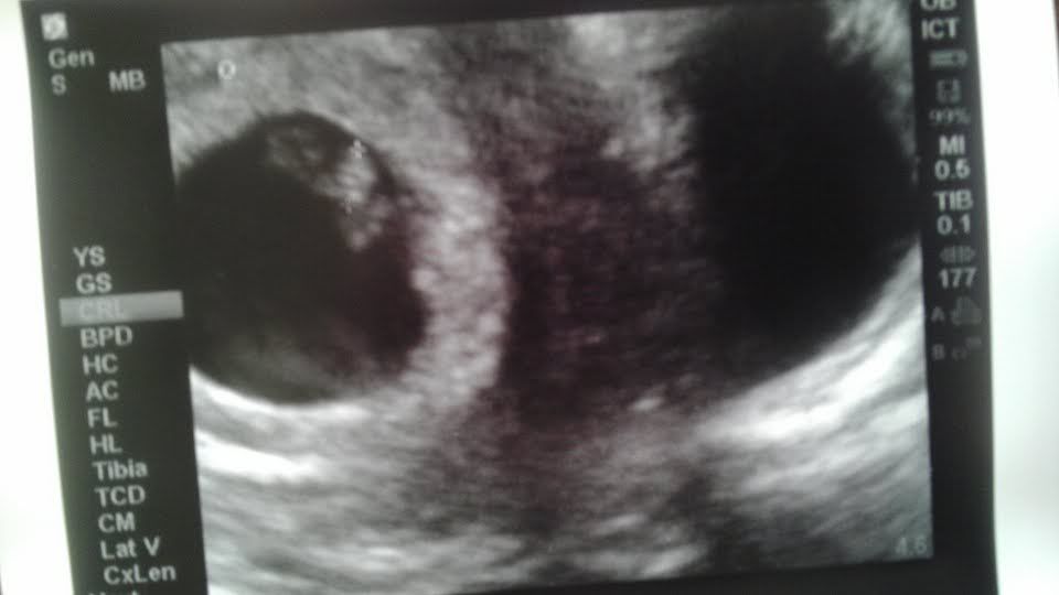 Hidden Twin 6 week u/s? BabyCenter